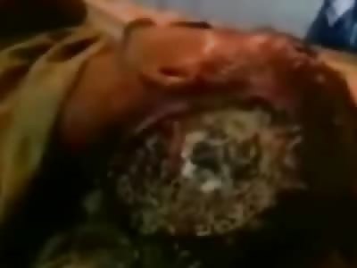 Man being Eaten Alive by Bugs from the Front and back of his Skull