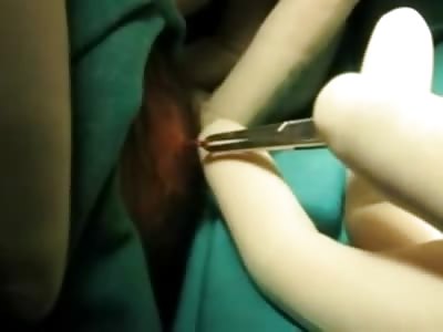 WTF: 5 inch Needle pulled out of Newborn Baby's Skull