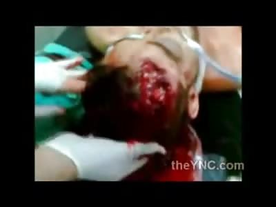 Man Dying on Operating Table Bleeding Brains