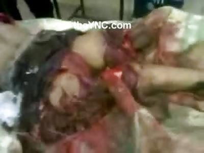 Hell: Girl in Syria is Completely Blown Apart in Hospital Emergency Room