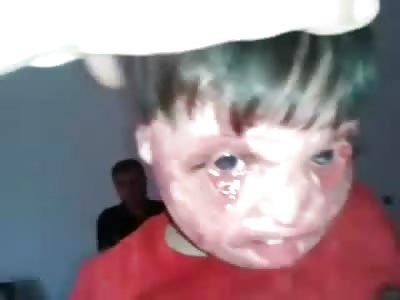 Shocking Video of 4 Year Old Boy with his Face Burned Off in Syria
