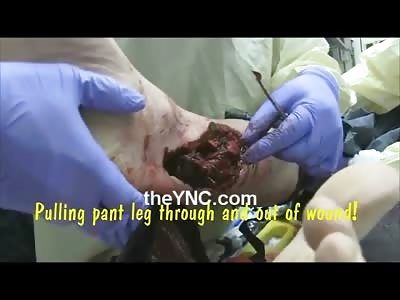 Muscles Moving inside of Leg after Painful Chainsaw Accident