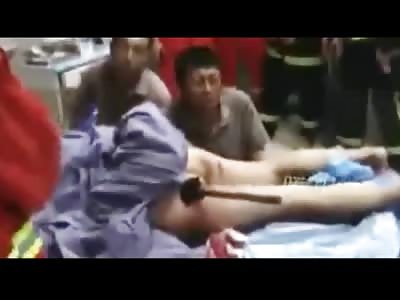VERY BIZARRE: Woman on Operating Table Has Huge Metal Rod Stuck up her Ass