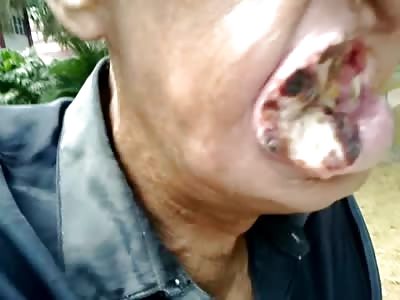 Homeless man with Horrible Mouth Disease....Cigarettes?