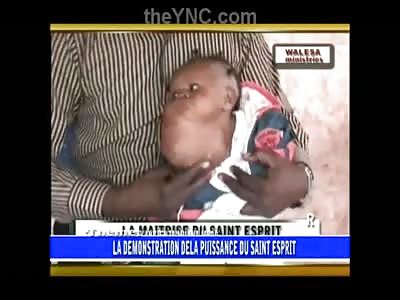 Very Sad Video of Little Girl Effected with Horrific Tumor in the Neck From African Worms