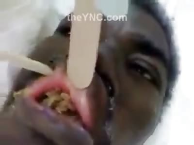 Mans Mouth is Infested with Maggots... I mean How the Fuck?!?!?!