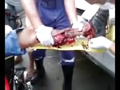 Oh my God...man with Horrific Injuries Screams in Agony as EMT's try to Save his Leg