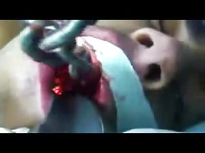 Man Brutally Tortured by Having a Metal Chain Shoved down his Throat Has it Painfully Removed