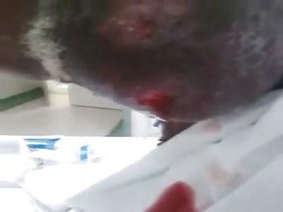 Huge Tumor Leaking Blood out of Mans Face
