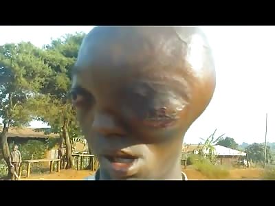 Very Sad Video of Boy looking for Help with a Huge Tumor on his Face 