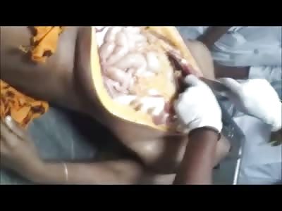 Full Autopsy and Suturing of a Pregnant Female who Committed Suicide by Hanging 