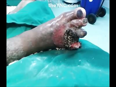 YNC Exclusive Video sent to Us from a Nurse in Brazil...Rotting Foot Up Close 