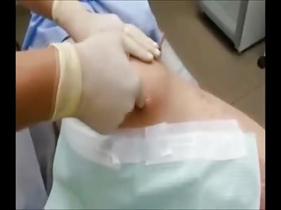 Disgusting Infection on Mans Ass has Coagulated Blood Pooled Up 