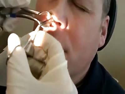 Big Ass Booger Pulled Out of Nose.