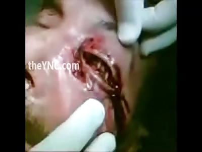 Disgusting: Man With Eye Full of Maggots!