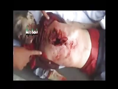 Short video of a little boy with a big hole in the chest