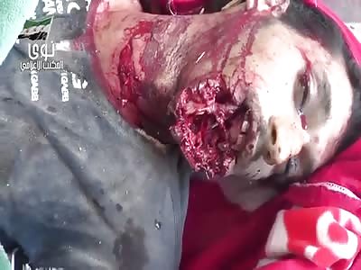 Close UP to a Dead Man with His Jaw Ripped Apart