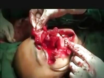 Pretty Amazing Video of Doctors Reconstruction a Man's Messed Up Face 