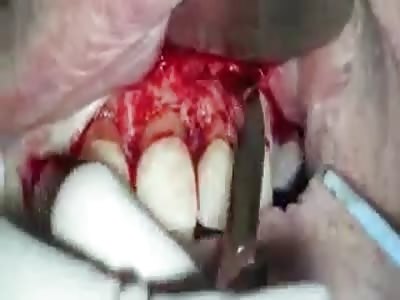 Anterior Periapical Surgery......OUCH!