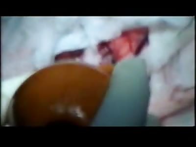 Removing a HUGE Brain Cyst