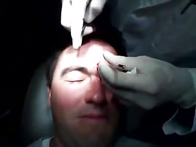 Worst Place for a Cyst - Bro I Saw Your Skull