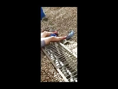 Foot Removed from Train