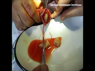 An operation to remove the stones from the bladder