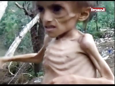 YEMENI VIDEO TRY TO LINK UNDERNOURISHED CHILD TO CHEMICAL WEAPONS USE BY SAUDI ARABIA