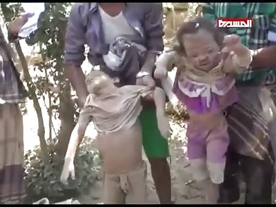CHILDREN AFFECTED IN THE YEMEN NORTH BOMBARDMENT