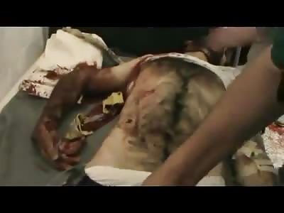 Landmine victim in Homs.
