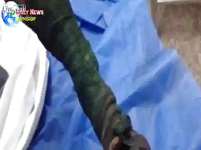  Girl's leg rot, mummified after venomous snake bite | WARNING: GRAPHIC CONTENT  