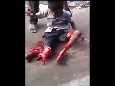Horrible Accident Leaves Boy in Dispair with His Leg Ripped Apart