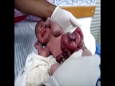 baby with exposed viscera 