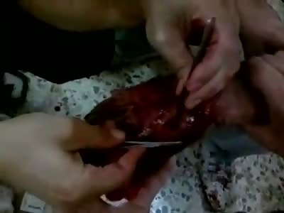 Syrian sewing destroyed hand.