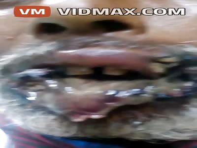 This Indian man has the worst case of herpes ever! Or his lips are just infected with maggots